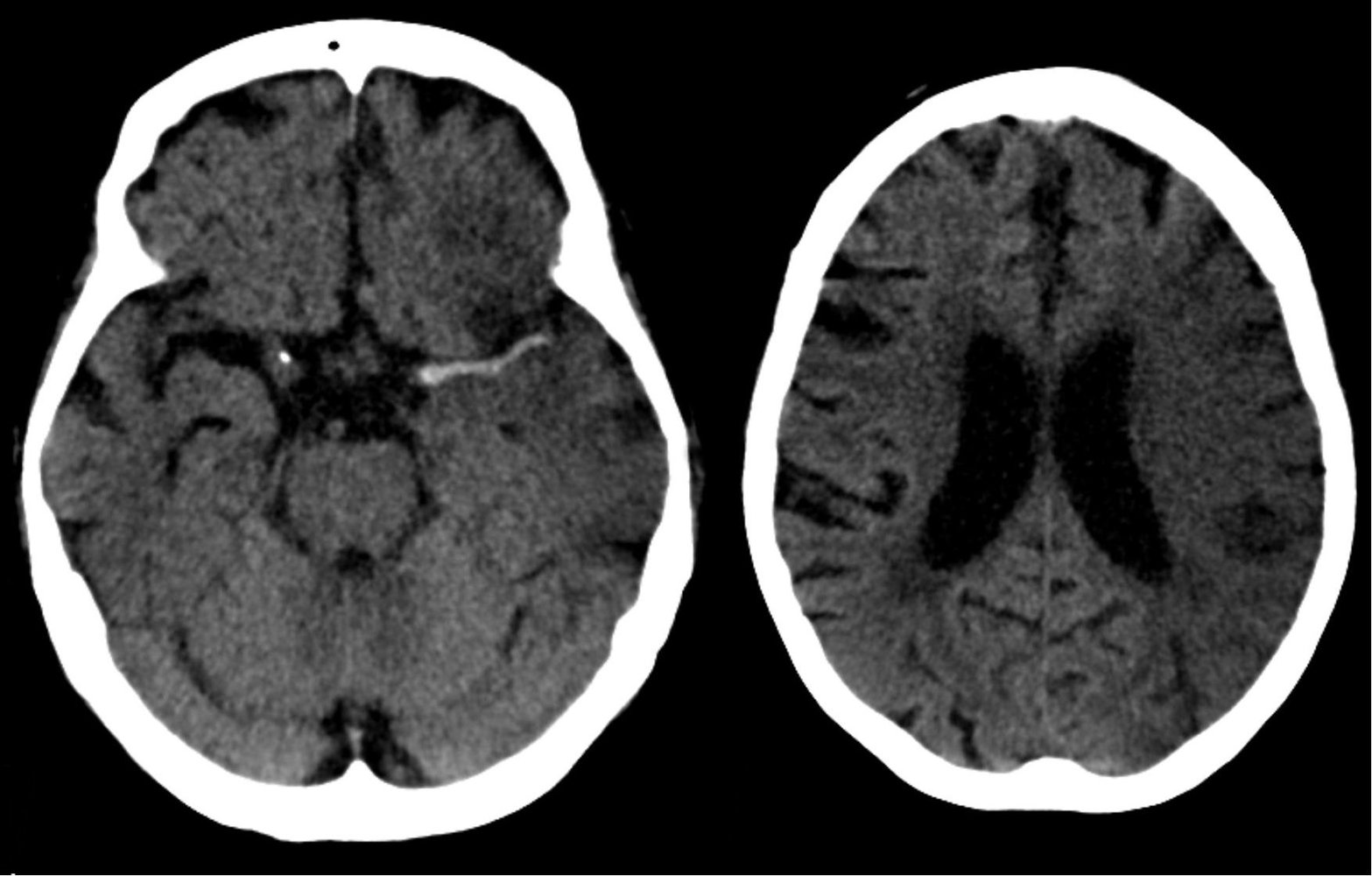 Hyperdense middle cerebral artery sign in stroke