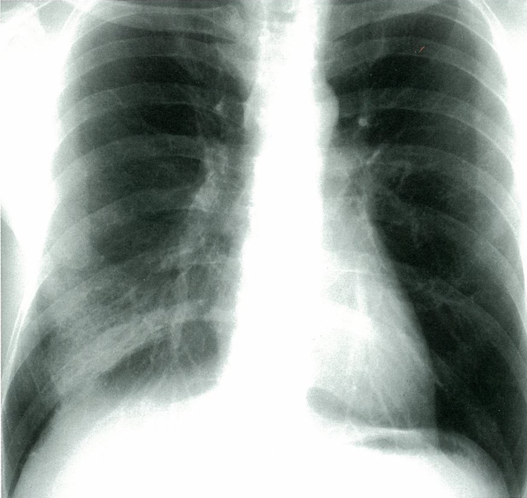 Right lower lobe opacification in pneumonia (1/2)
