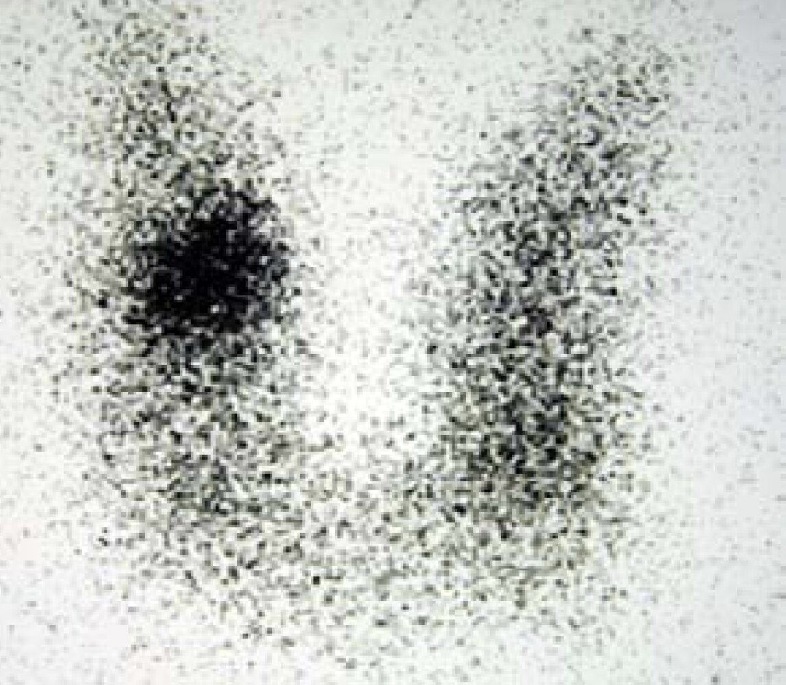 Thyroid scan hot nodule