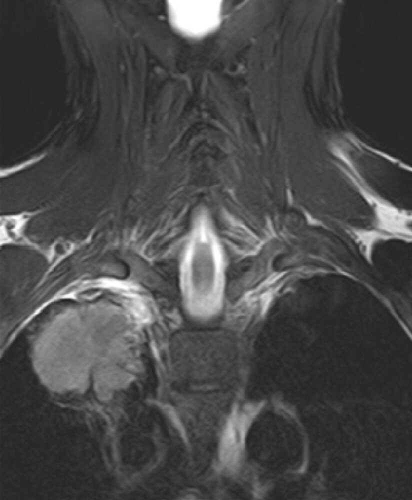 Pancoast tumor