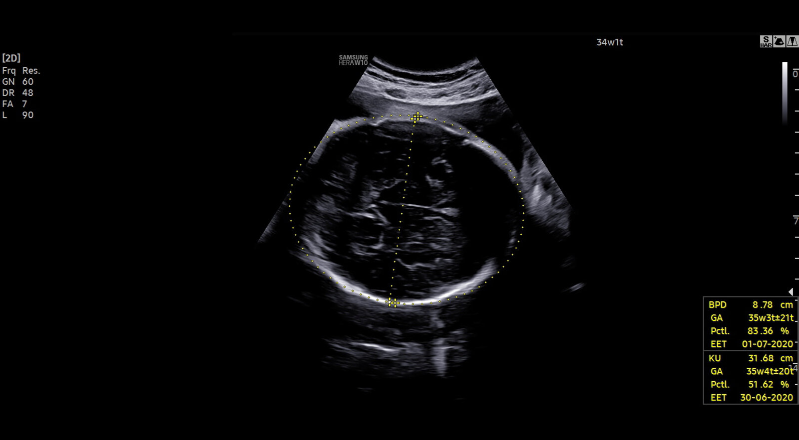 Fetal biometry: biparietal diameter and head circumference