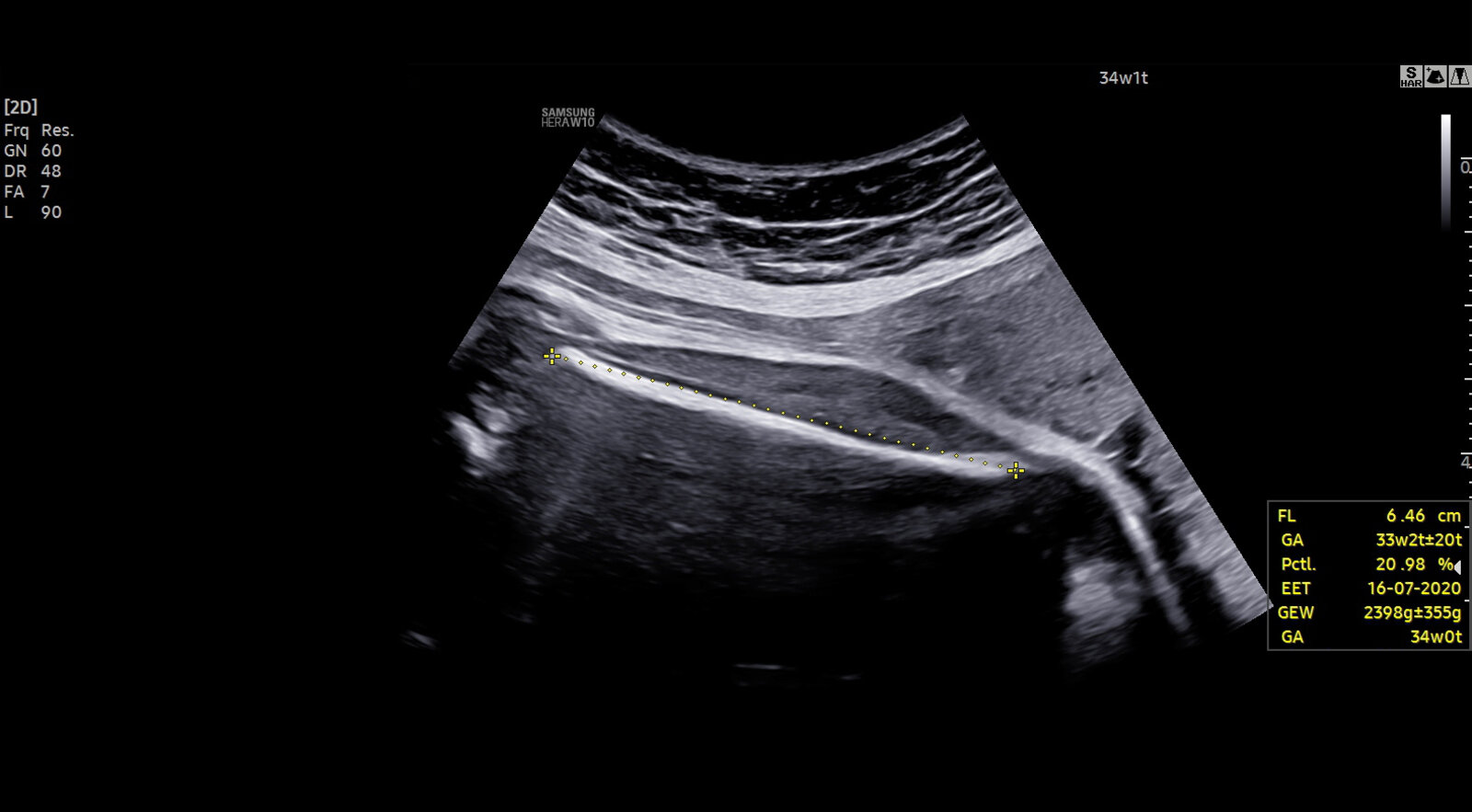 Fetal biometry: Femur length (FL)