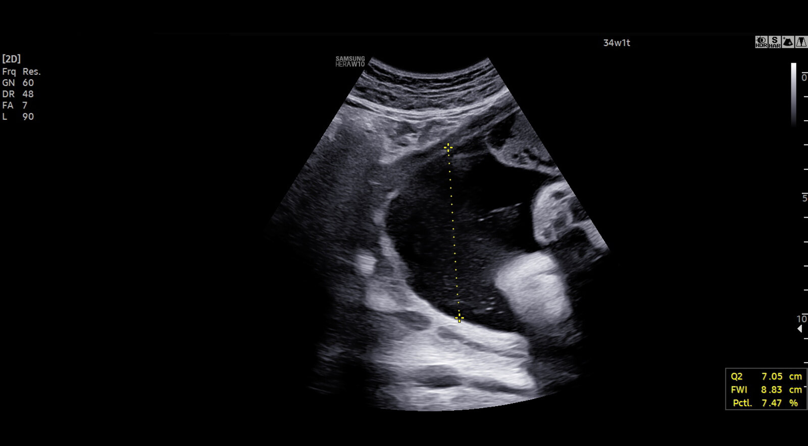 Amniotic fluid index (1/2)