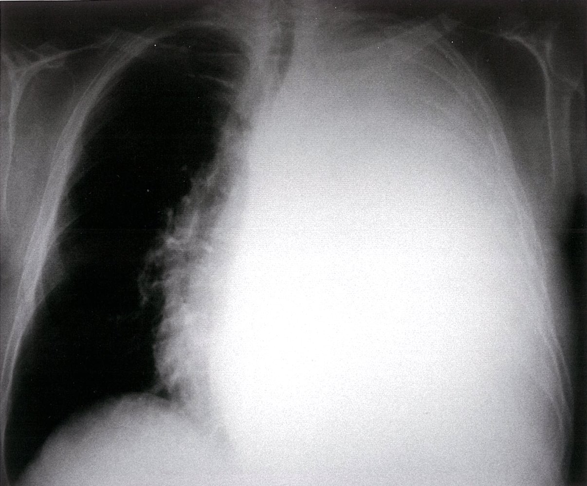 Pleural effusion with mediastinal shift