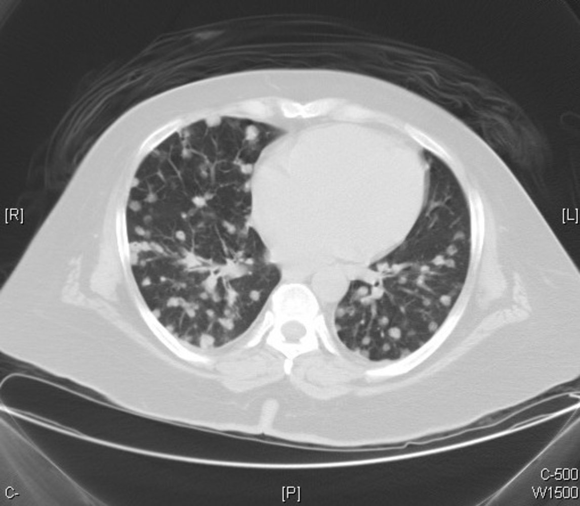 Small pulmonary nodules