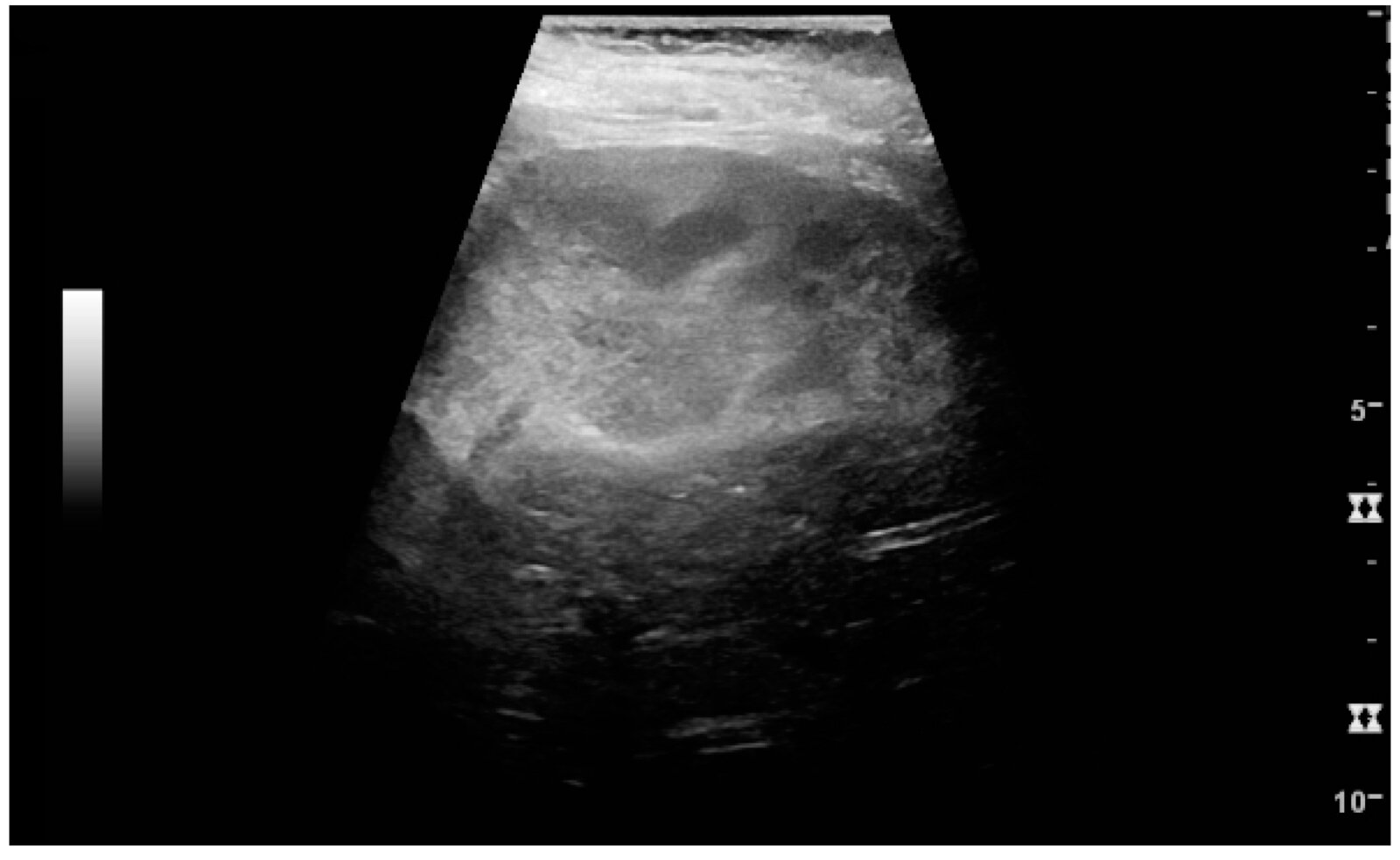 Pyelonephritis