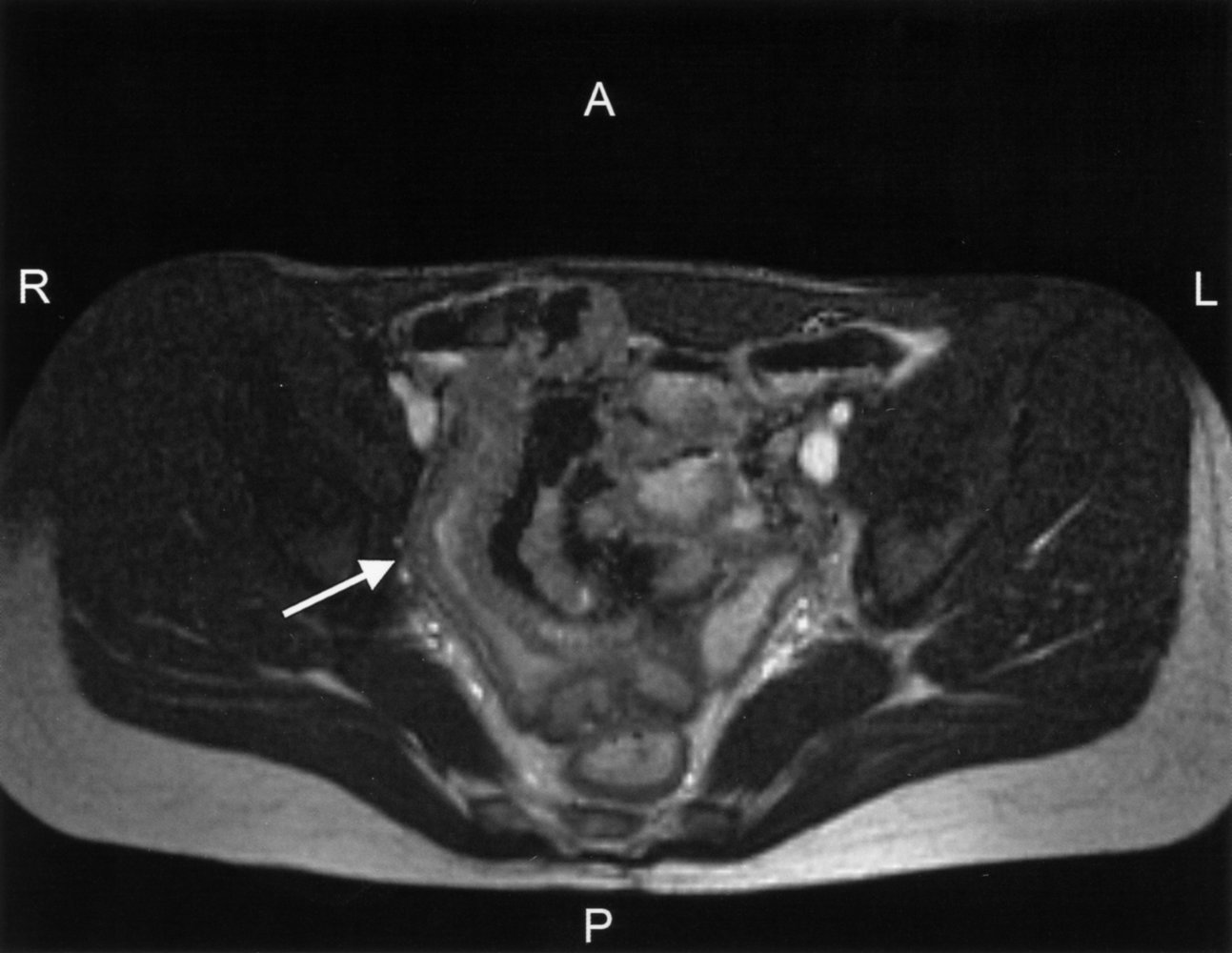 Stricture of the terminal ileum
