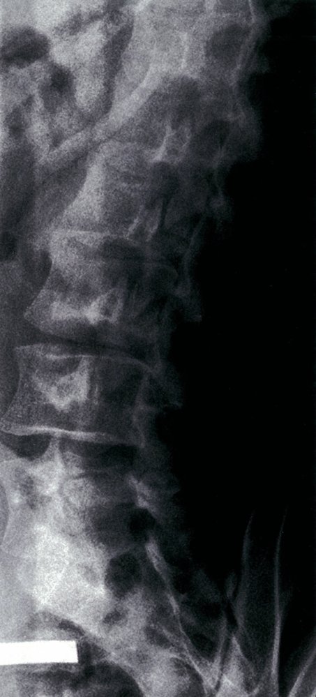 Spondylolysis (Scottie dog sign with collar)