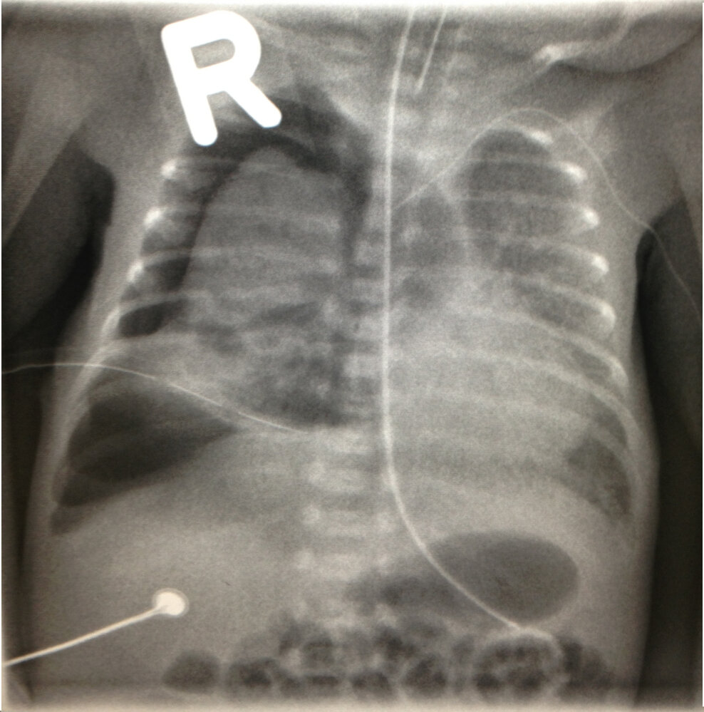 Respiratory distress syndrome (3/3)
