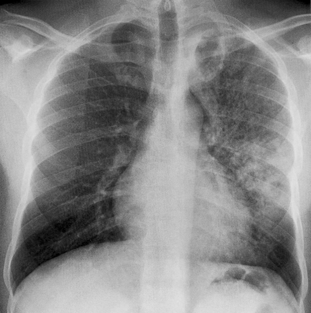 Post-primary pulmonary tuberculosis