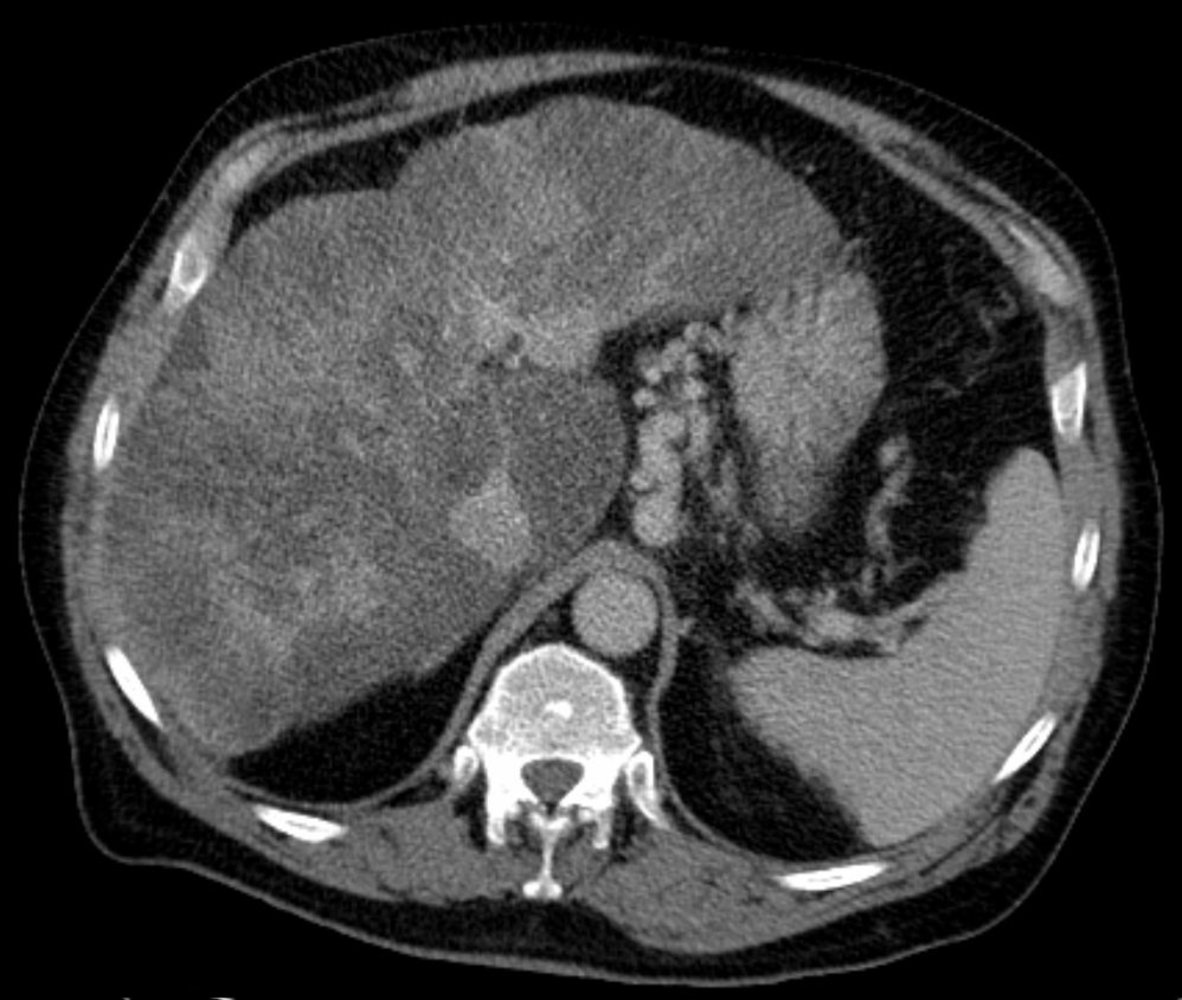 Varices in hepatic cirrhosis