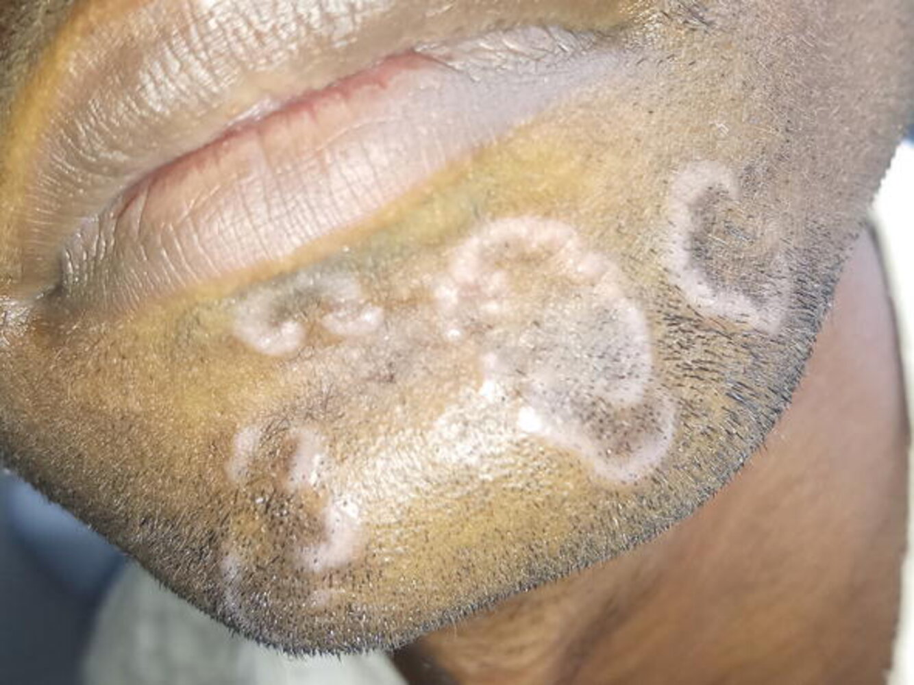 Localized granuloma annulare