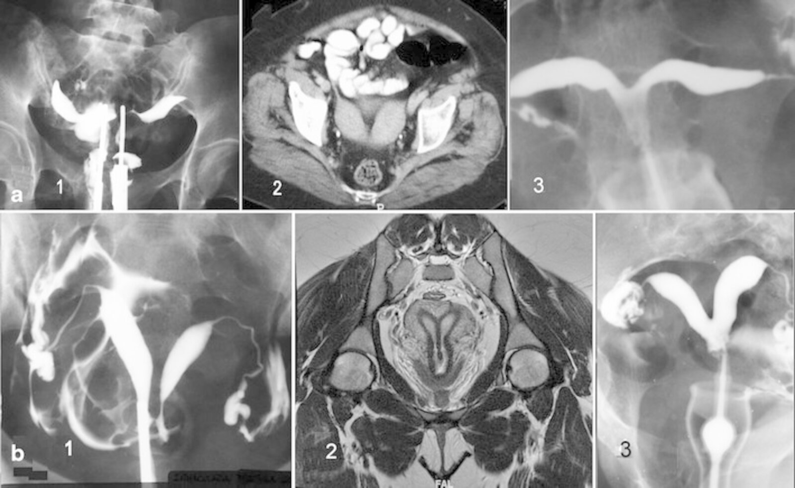 Imaging of uterine anomalies