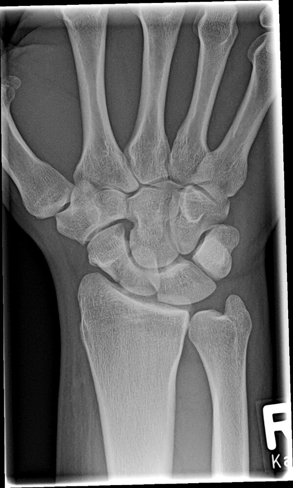 Scaphoid fracture