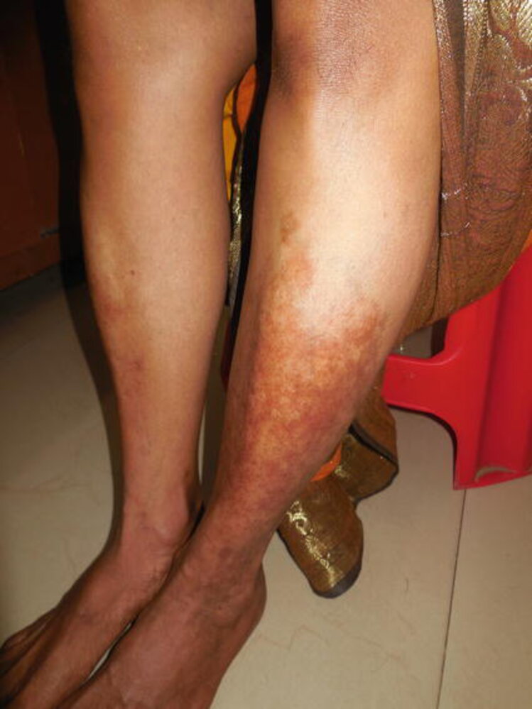 Necrobiosis lipoidica
