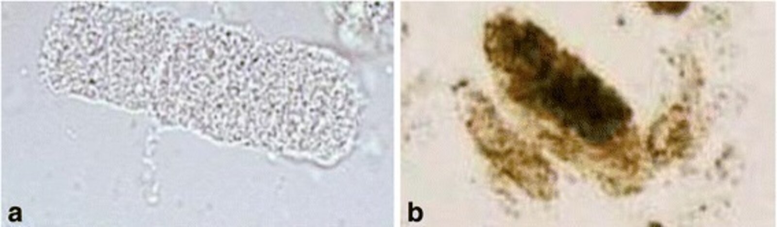 Urine casts in acute tubular necrosis