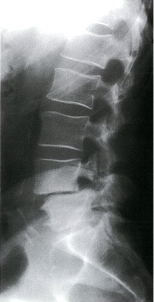 Spondylolisthesis