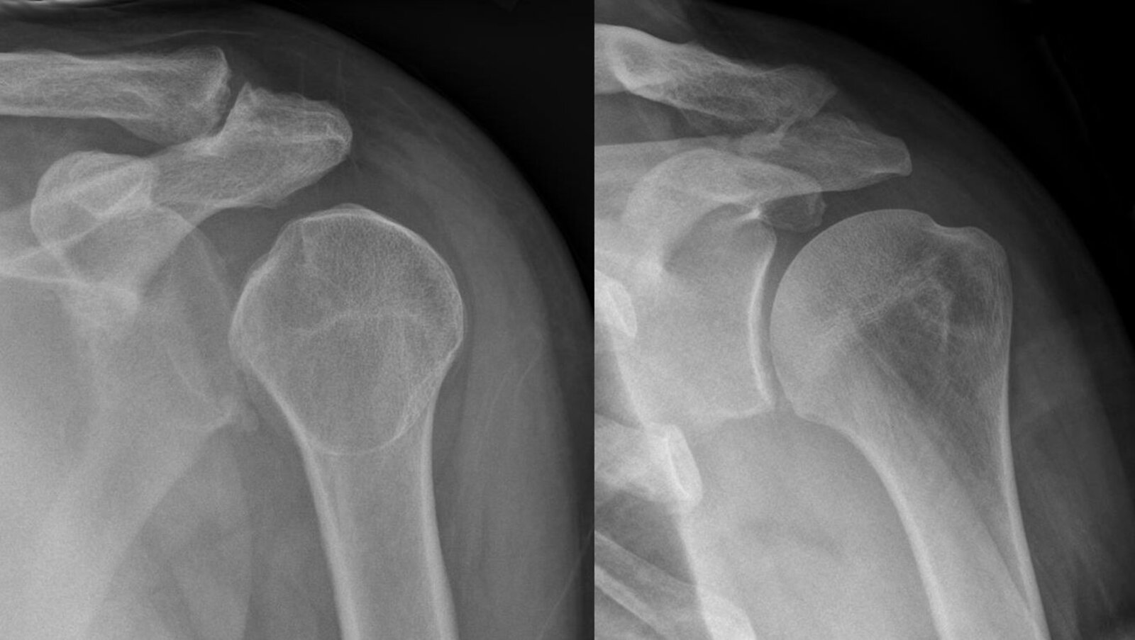 Lightbulb sign (posterior dislocation of the humerus)