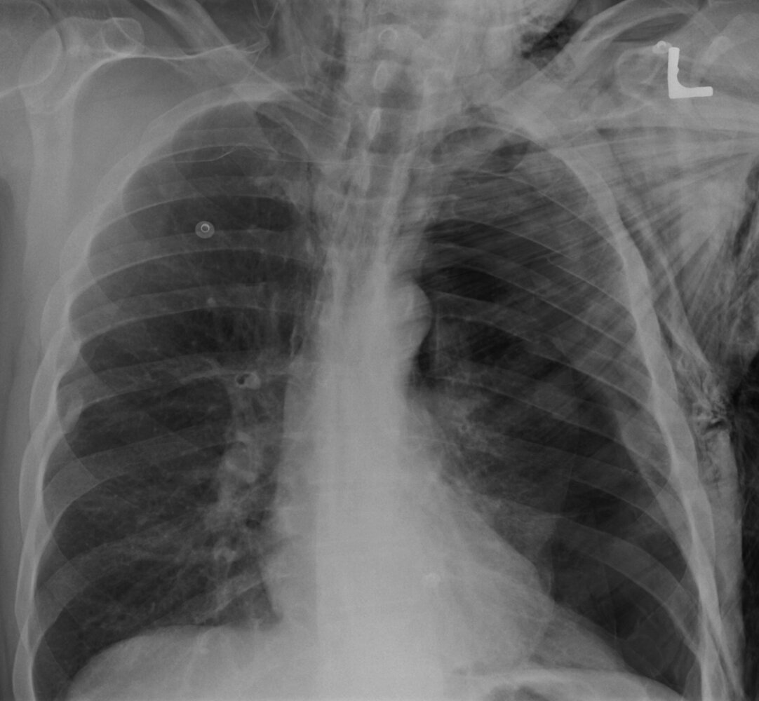 Tension pneumothorax with mediastinal and subcutaneous emphysema