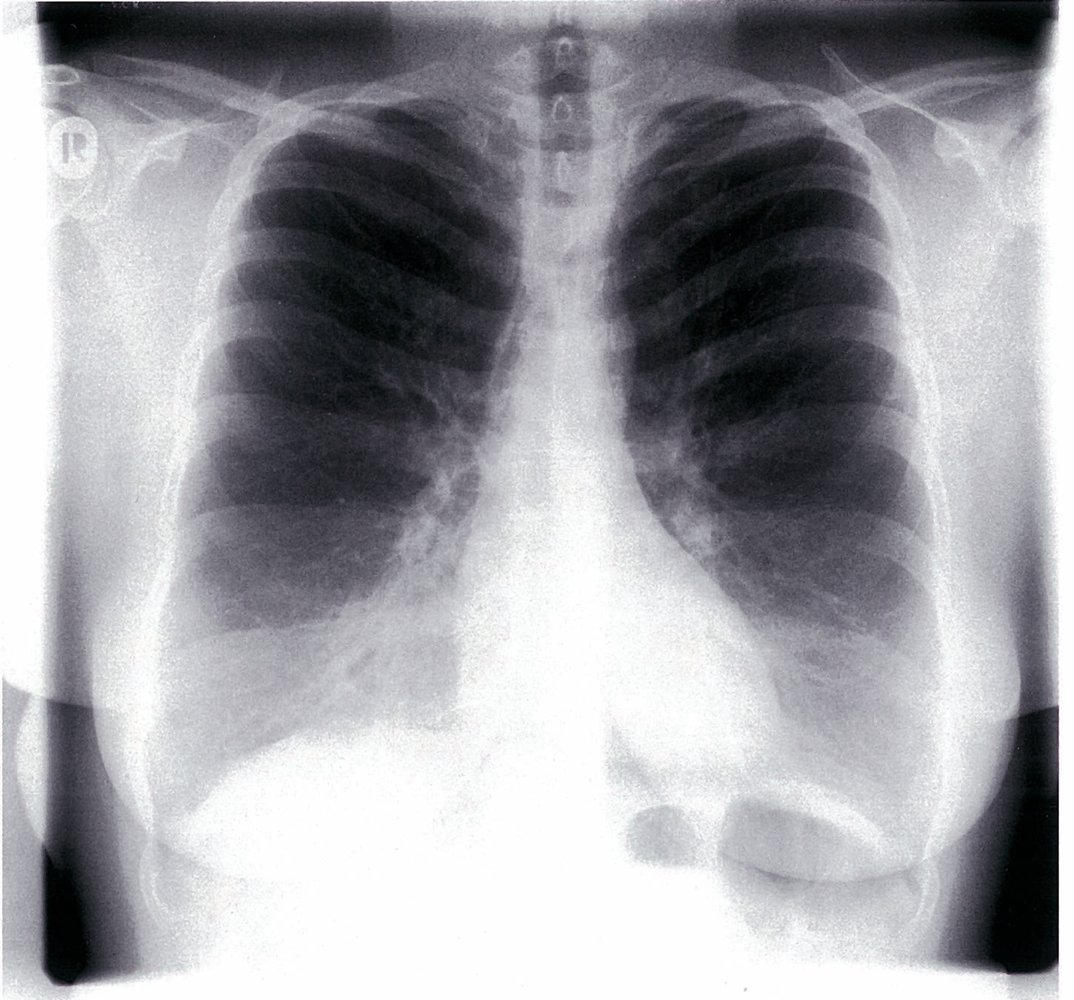 Pulmonary hyperinflation (1/2)