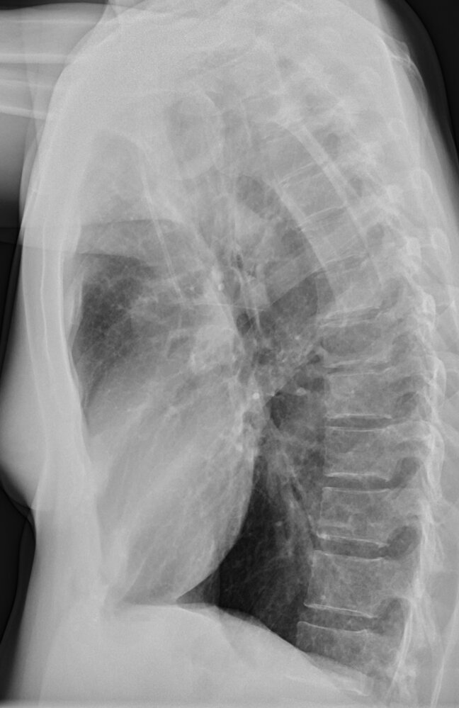 Normal chest radiograph (lateral view)