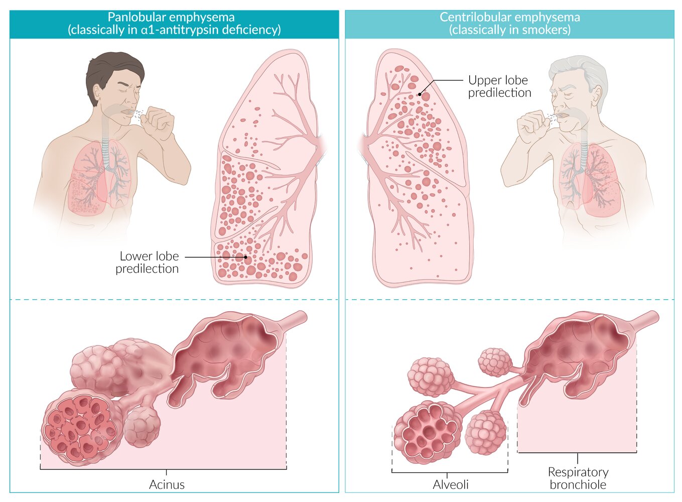 Centrilobular and panlobular emphysema