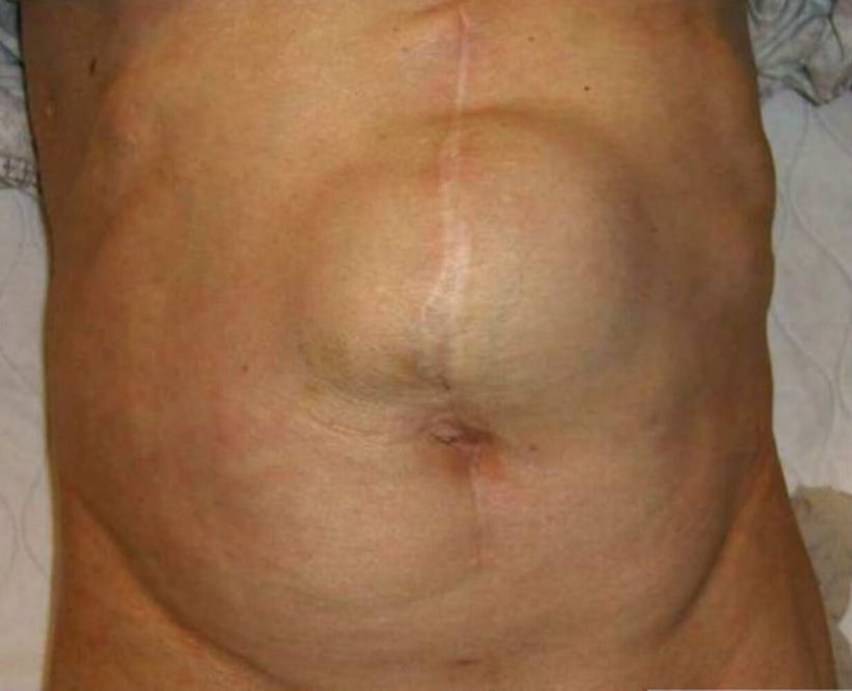 Incisional hernia