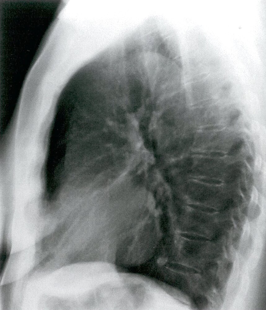 Left ventricular enlargement (2/2)