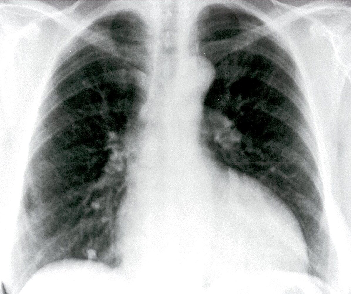 Left ventricular enlargement (1/2)