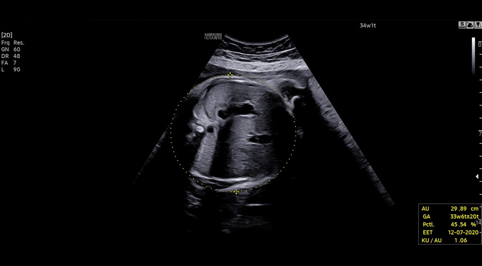 Fetal biometry: abdominal circumference (AC)