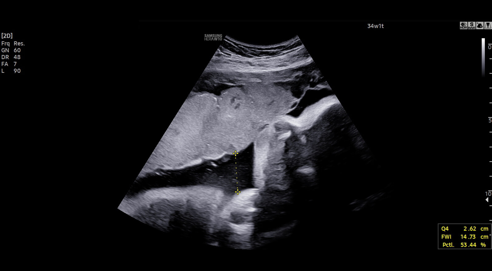 Amniotic fluid index (2/2)