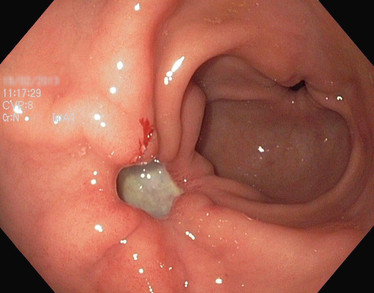 Gastric ulcer: Forrest stage III