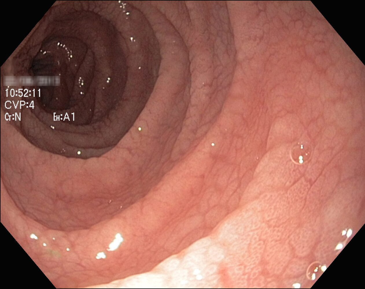 Celiac disease