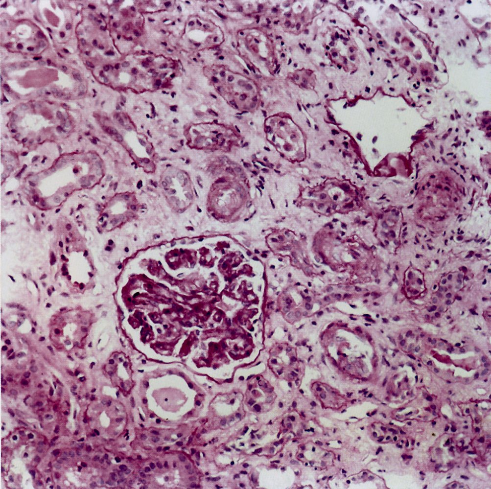 Nephrosclerosis following hemolytic-uremic syndrome (HUS)