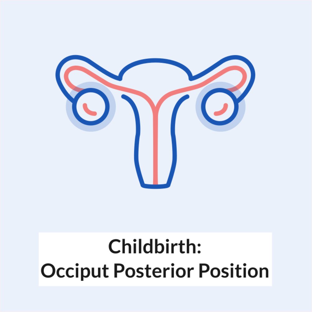 Animation: Childbirth - Occiput Posterior Position