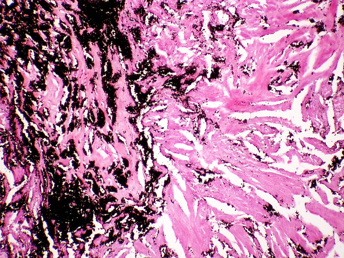 Anthracotic pigment in lung in coal worker's pneumoconiosis