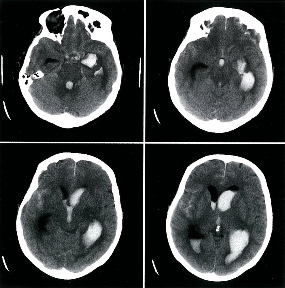 Intracerebral, intraventricular, and subarachnoid hemorrhage