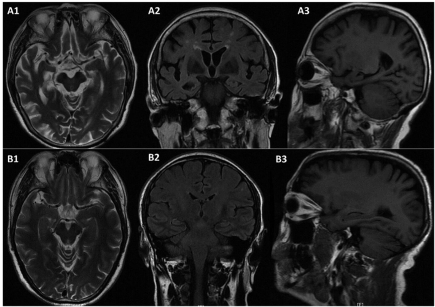 Cerebral atrophy in Alzheimer disease