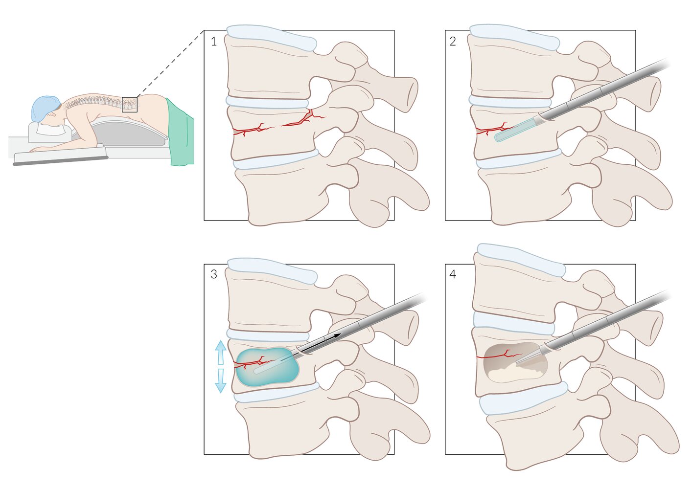 Kyphoplasty