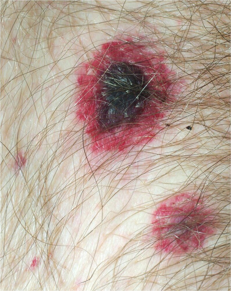 Ecthyma gangrenosum