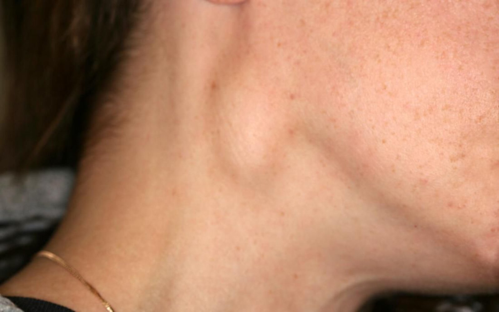 Lymphadenopathy