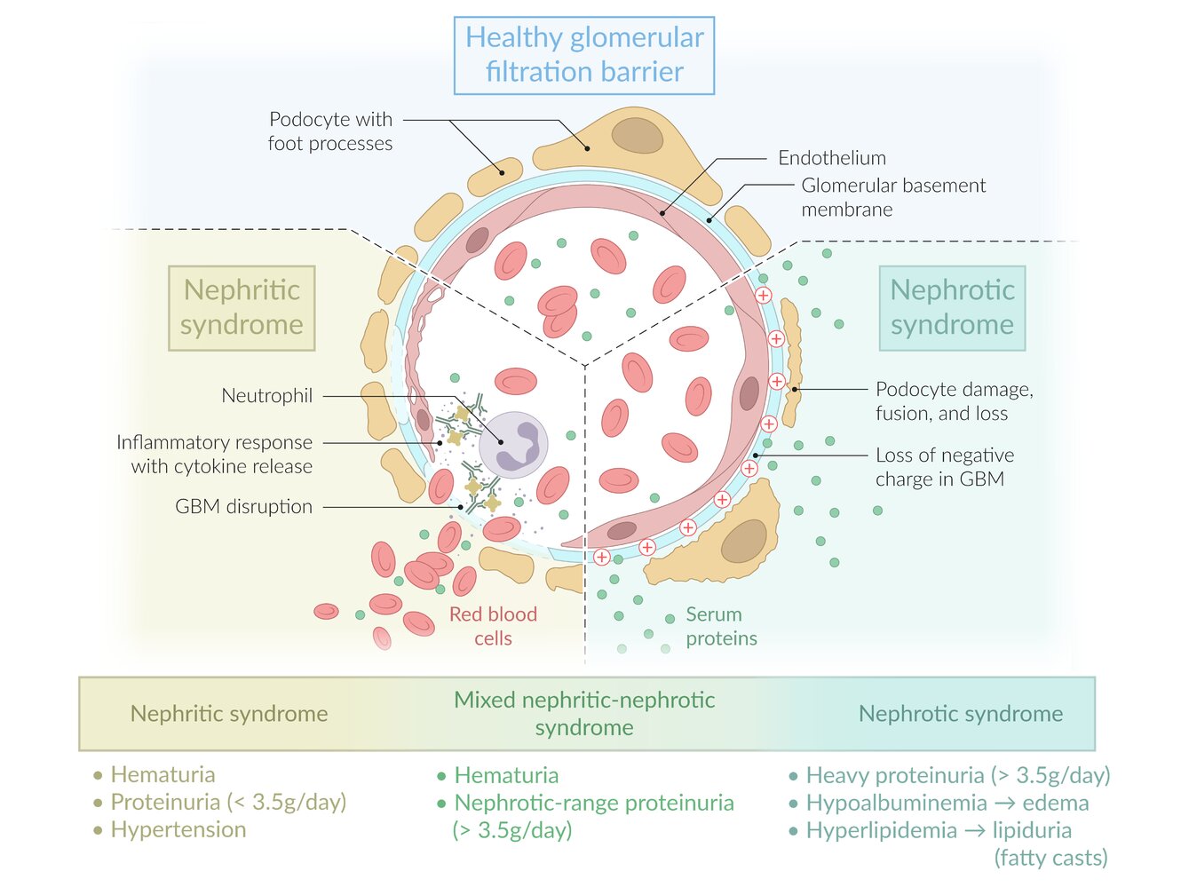 Nephritic and nephrotic syndromes