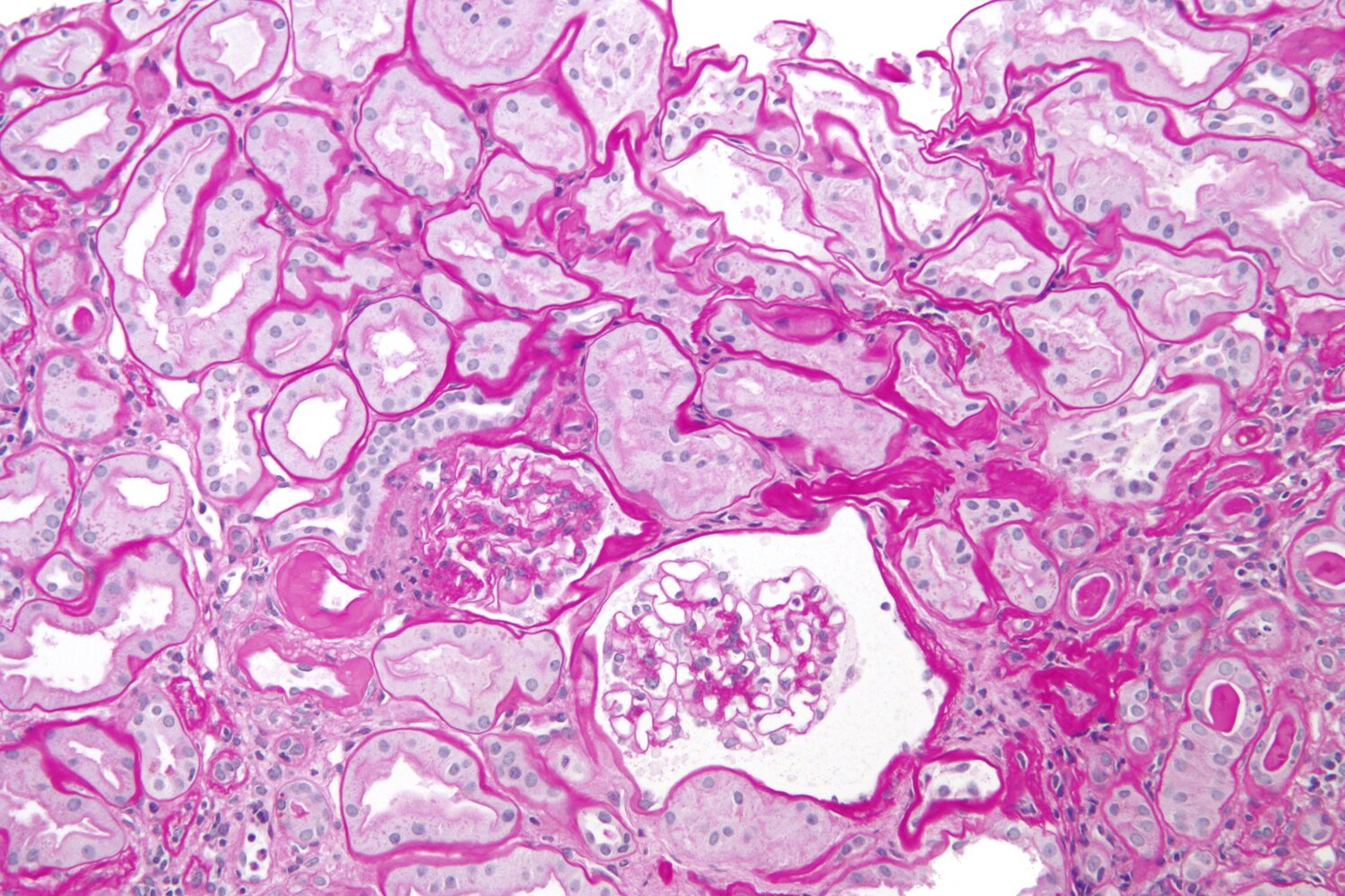Chronic transplant rejection in kidney