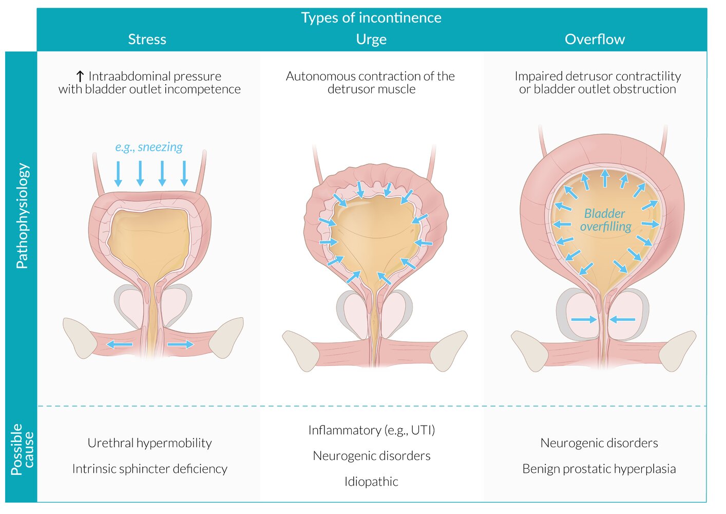 Urinary incontinence