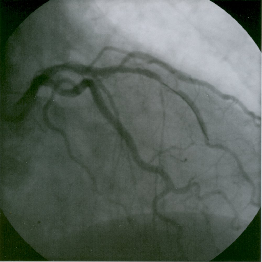 Coronary angiography (2/2)