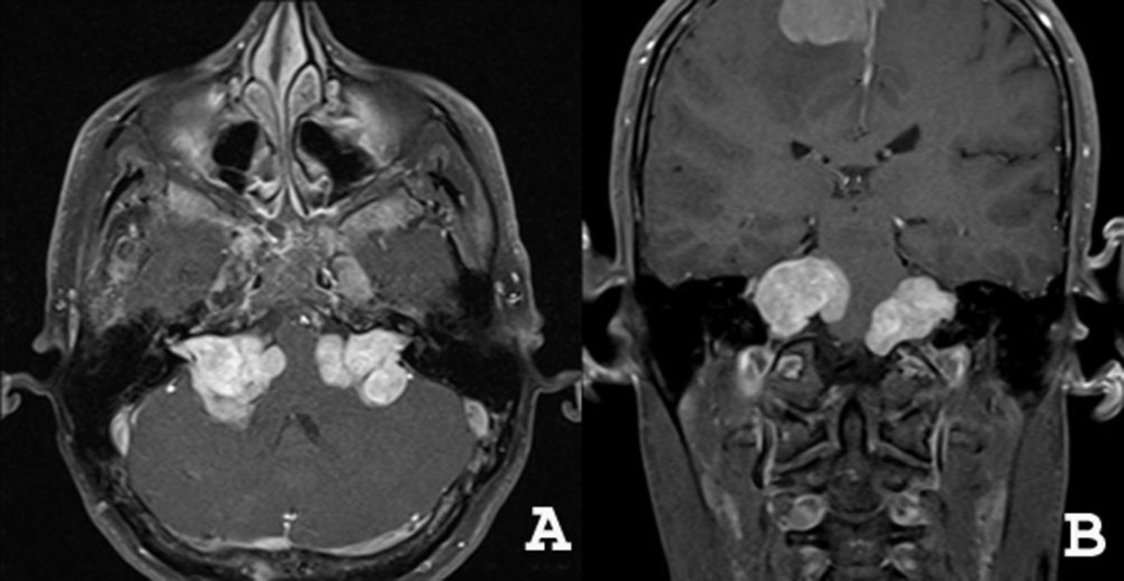 Vestibular schwannomas and parasagittal meningioma