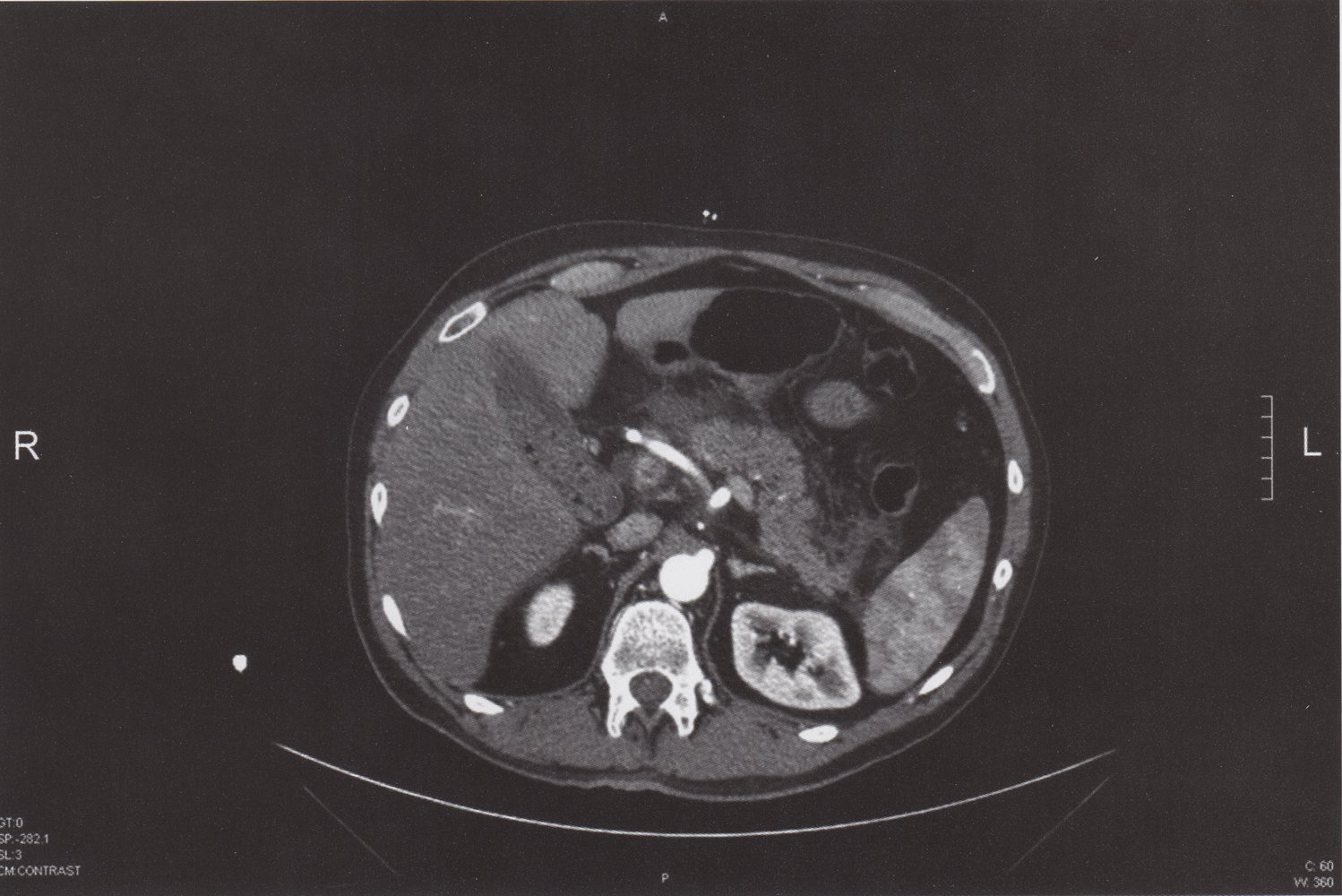 Acute pancreatitis