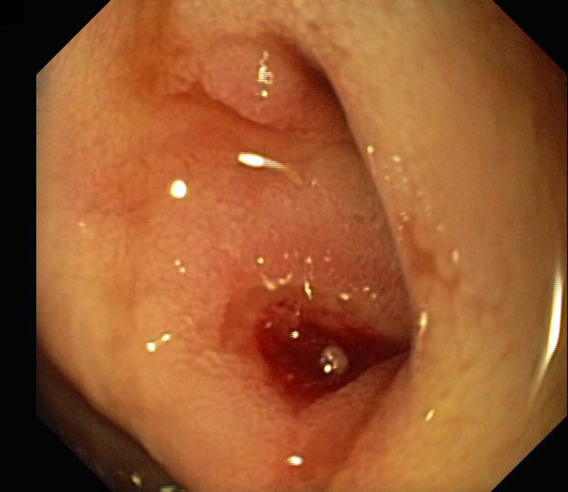 Duodenal ulcer: Forrest stage IIa