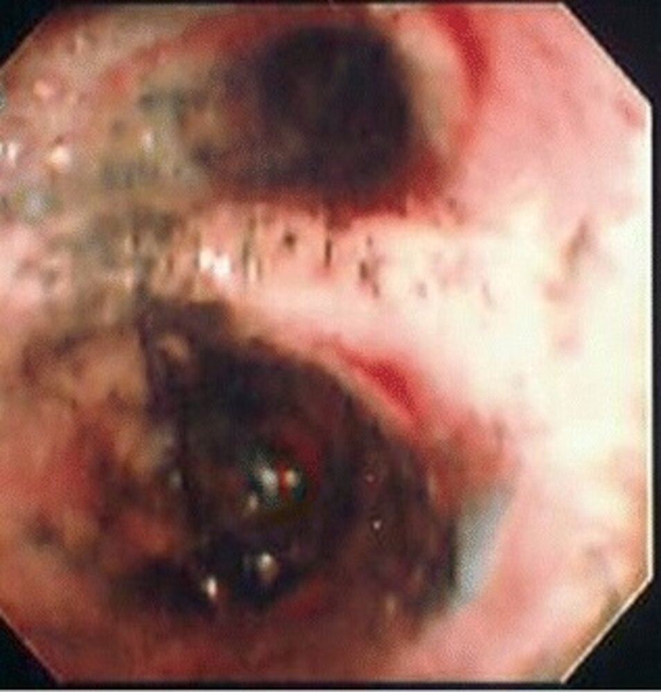 Inhalation injury of the upper airways