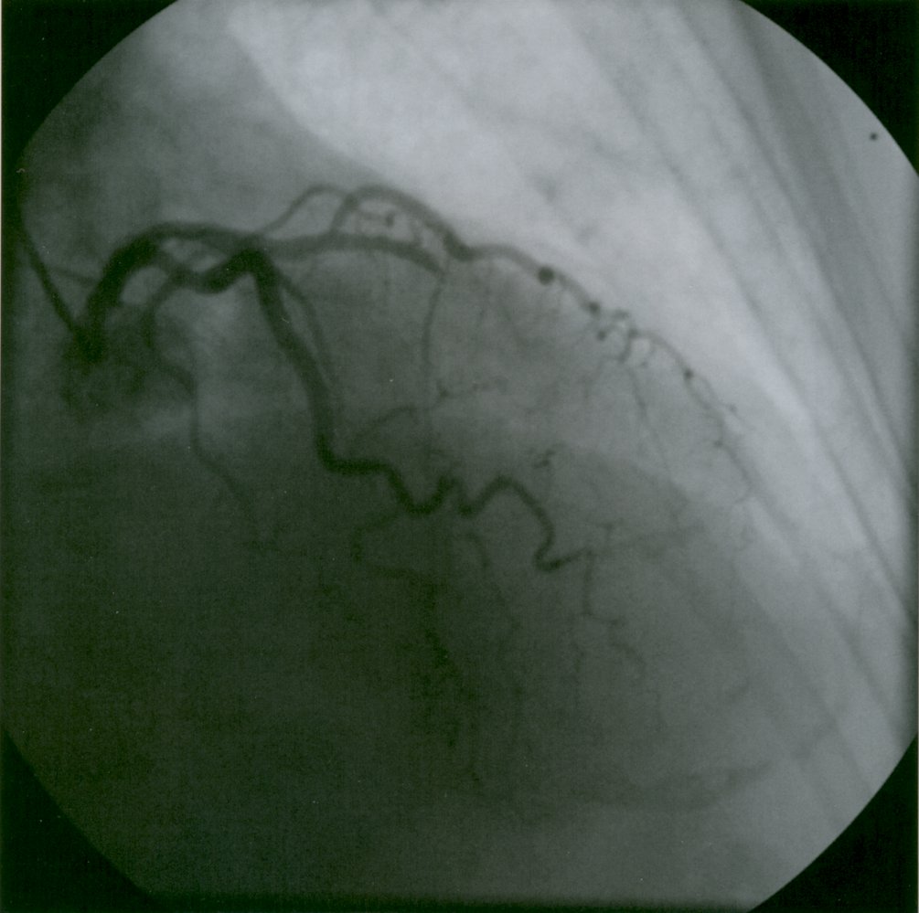 Coronary angiography (1/2)